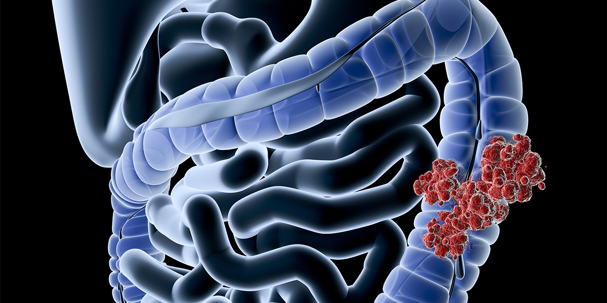 specific-gene-could-predict-colon-cancer-outcomes-discover-health